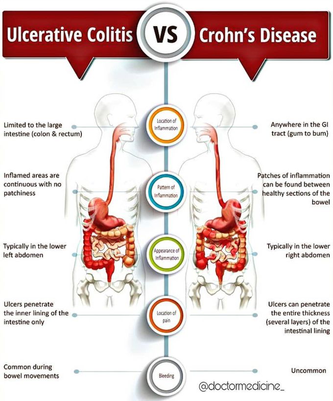 Difference between Ulcerative Colitis and Crohn's disease .