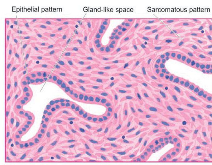 Malignant mesothelioma