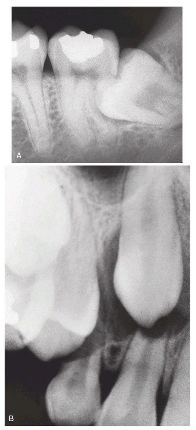 Sequela of impacted teeth