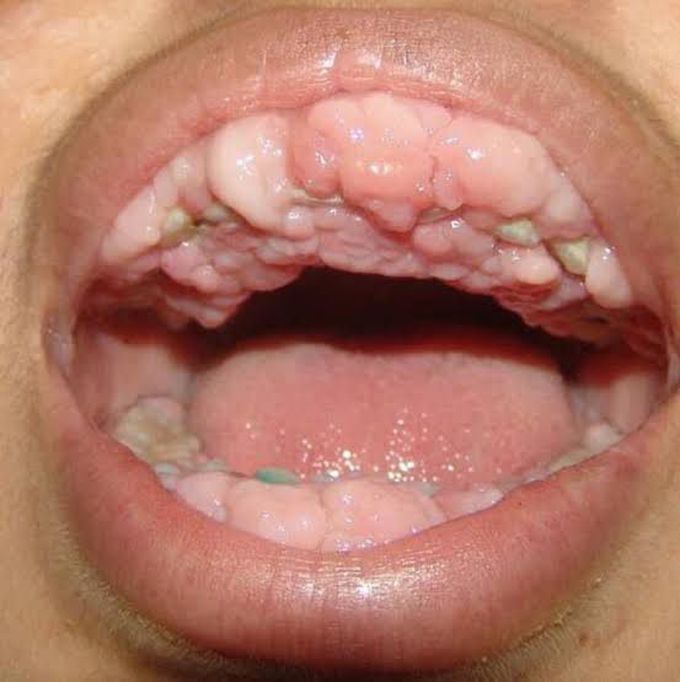 Drug induced gingival hyperplasia