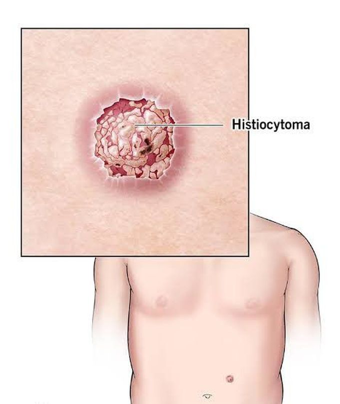 Fibrous histiocytoma