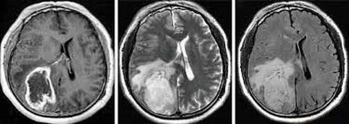 Cardinal Features of Brain Tumors