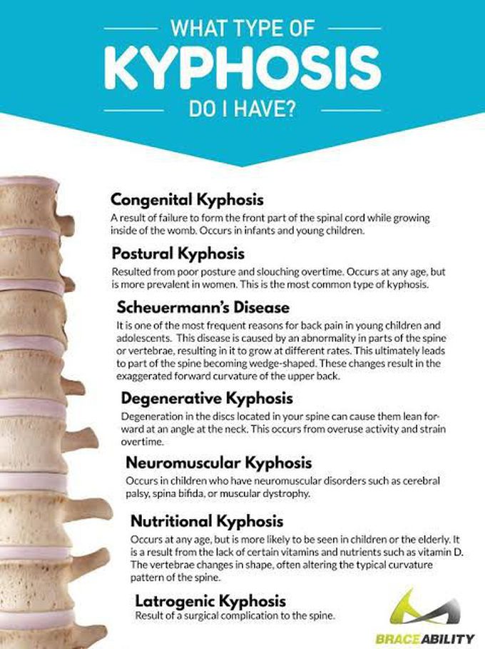Kyphosis types
