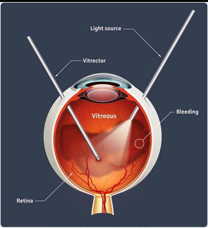 Vitrectomy