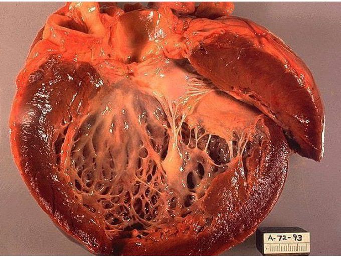 Dilated cardiomyopathy