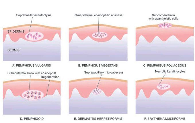 Location of bullae and vesicles in non-infectious bullous dermatoses.