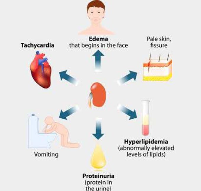 These are the symptoms of Nephrotic syndrome