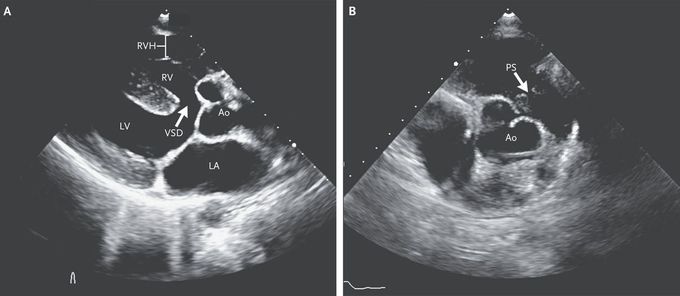 Unrepaired Tetralogy of Fallot in Adulthood