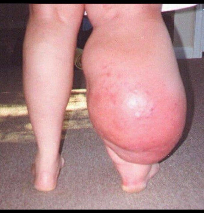 Lymphedema