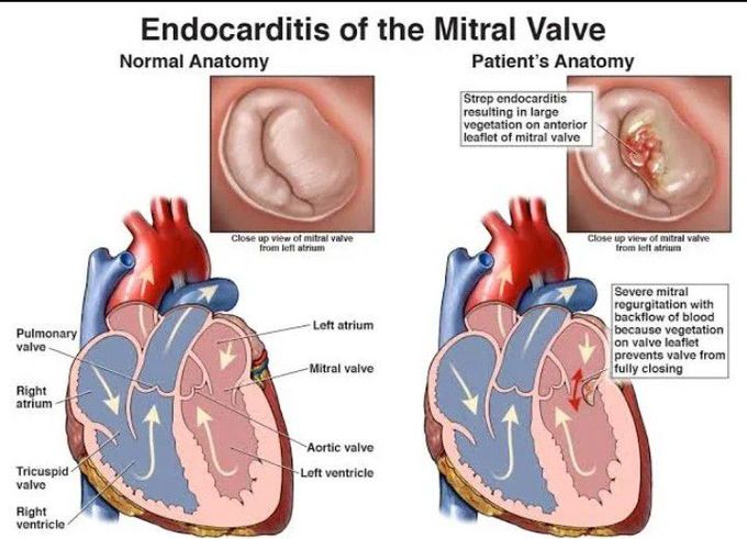 Mitral valve endocarditis