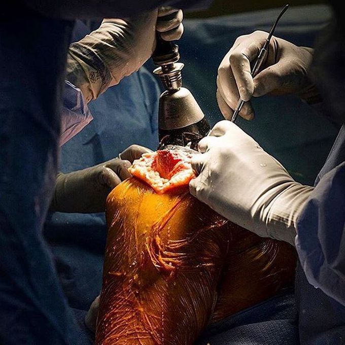 Knee replacement surgery, or knee arthroplasty!!!