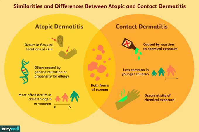 Atopic vs Contact Dermatitis