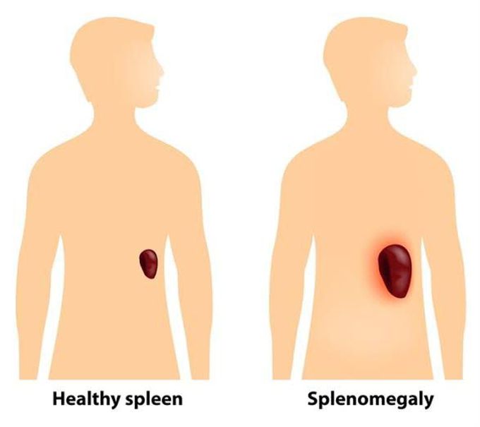 Splenomegaly