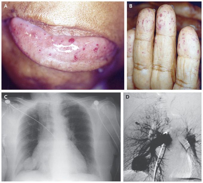 Hereditary Hemorrhagic Telangiectasia