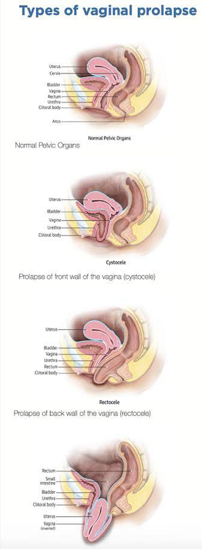 Types of Vaginal Prolapse