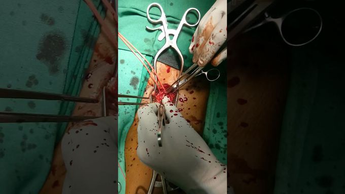 Femoral embolectomy