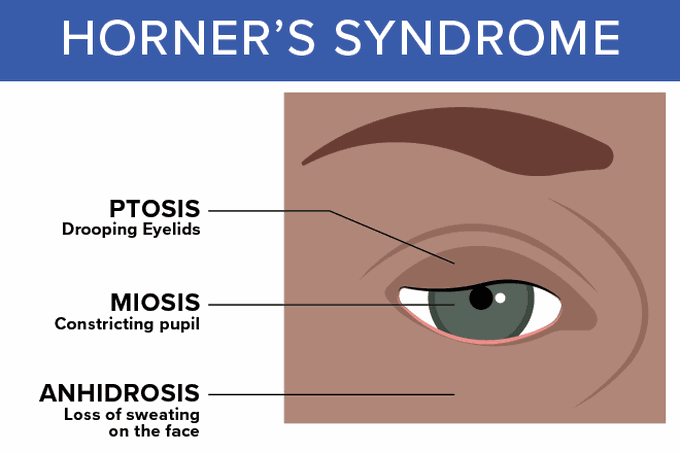 Horners syndrome symptoms
