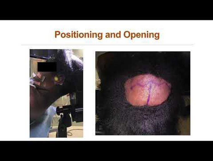 Posterior transcallosal intervenous-interforniceal approach to a periaqueductal tumor