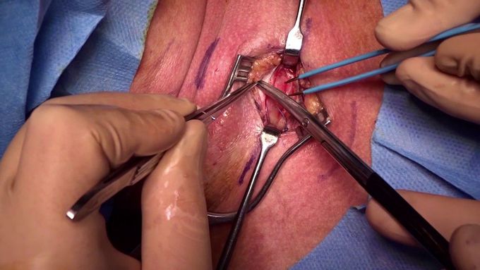 Surgical tracheostomy