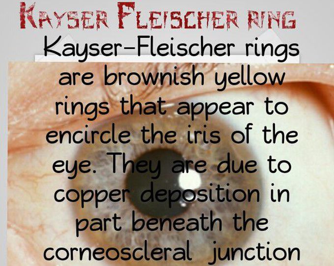 Kayser Fleischer ring