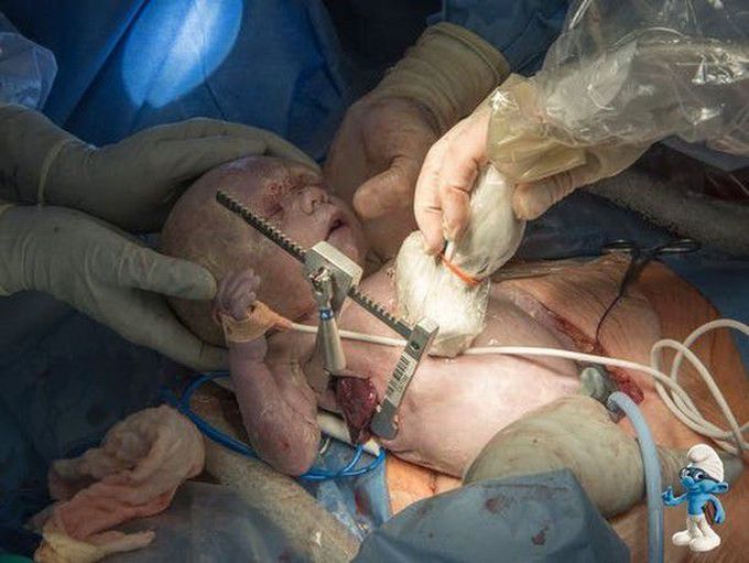 Fetal Surgery