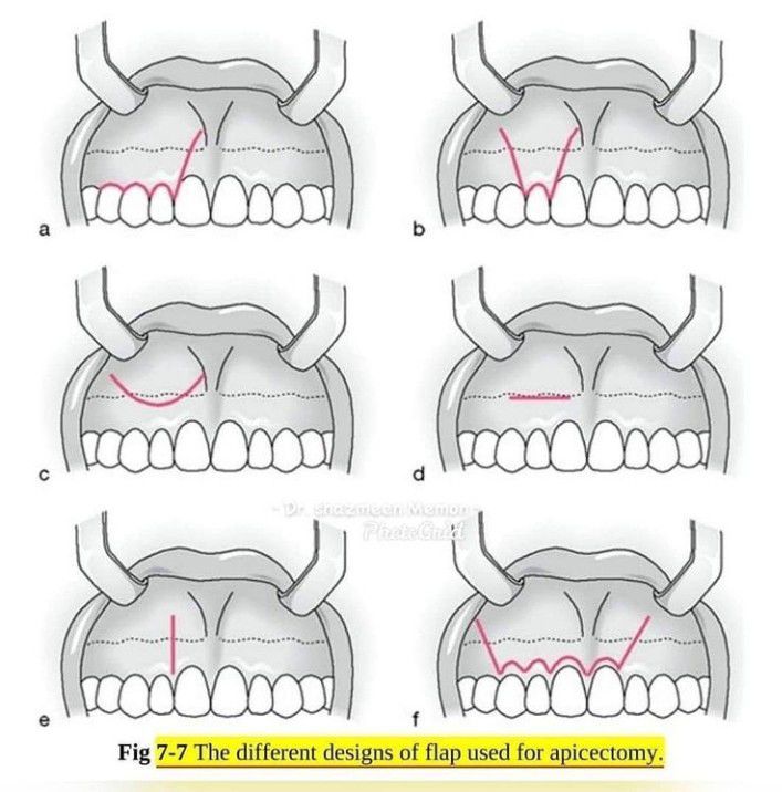 Different desgins of flaps used for apicectomy MEDizzy