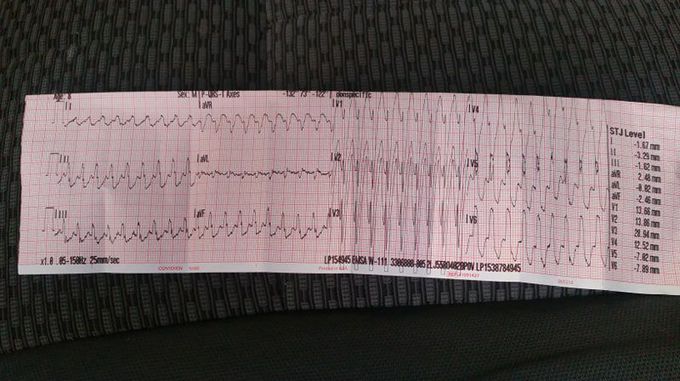 Name this rhythm and it's treatment.