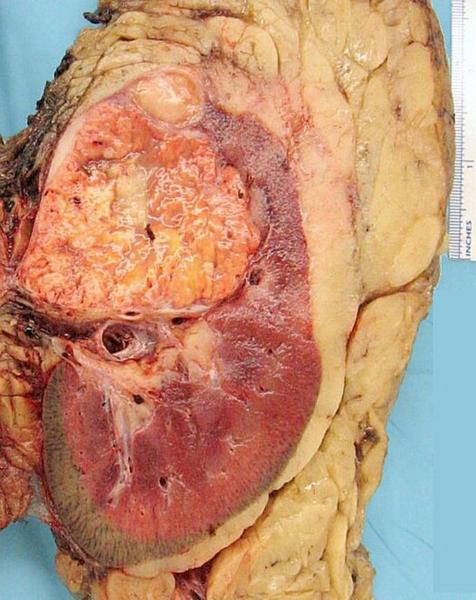 Renal cell carcinoma