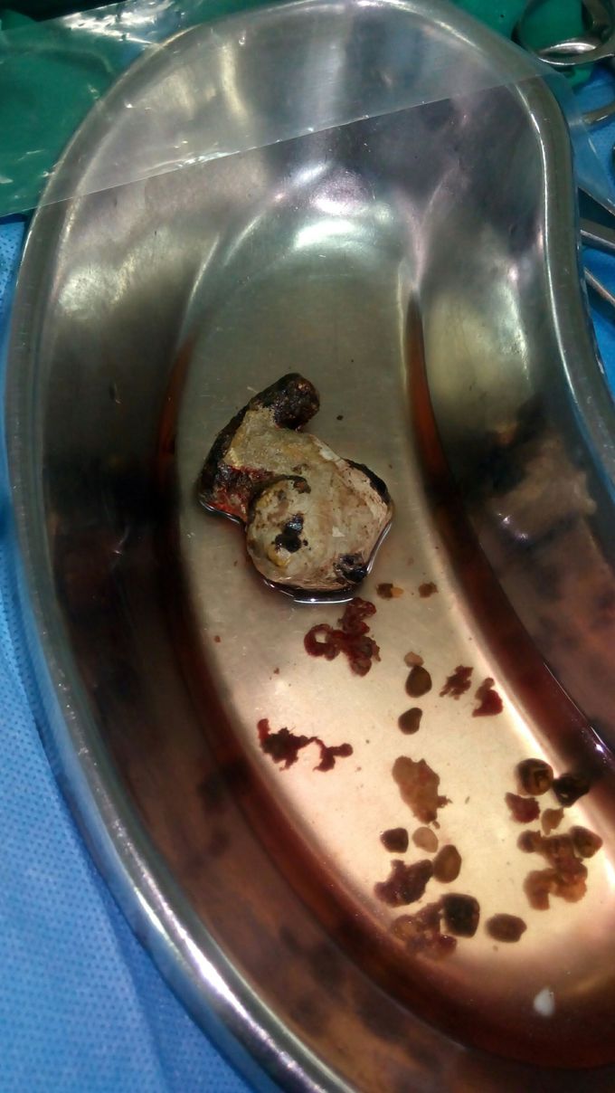 Kidney Stone