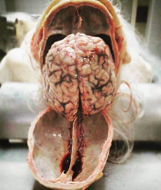Dissection