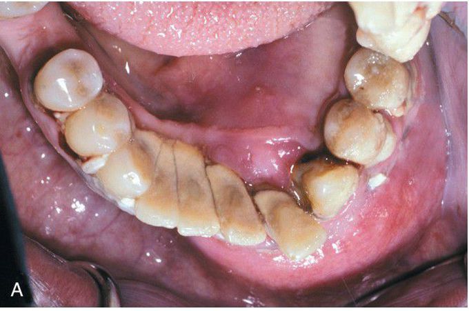 Ameloblastic Carcinoma.