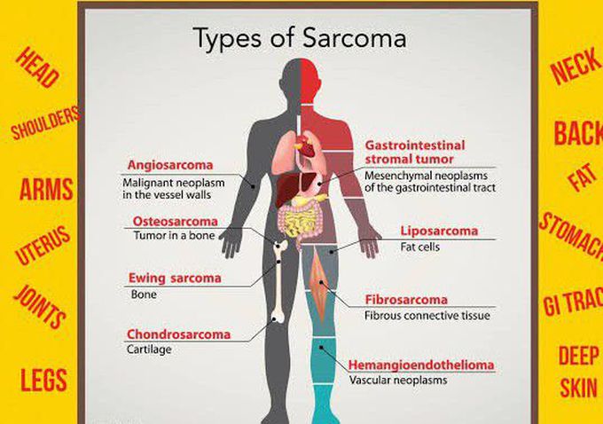 These are the types of Sacroma
