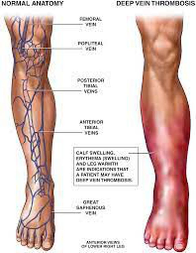 What treatments are available for people with deep vein thrombosis?