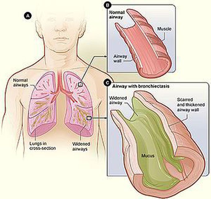 Symptoms of broncheictasis