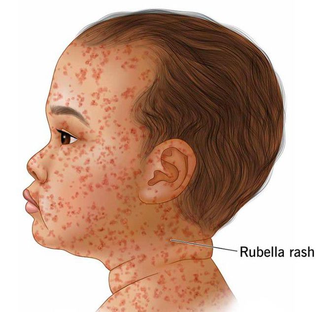 Symptoms of rubella syndrome
