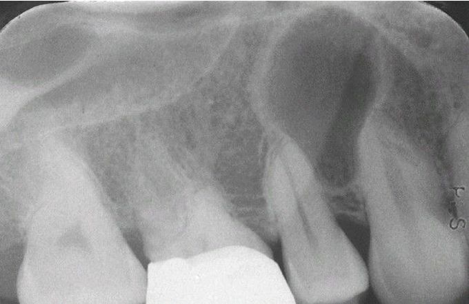 Surgical Ciliated Cyst.