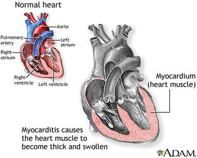 Etiology of Myocarditis are coxsakie and influenza virus , SLE , RA , Rheumatic fever , Sarcoidosis