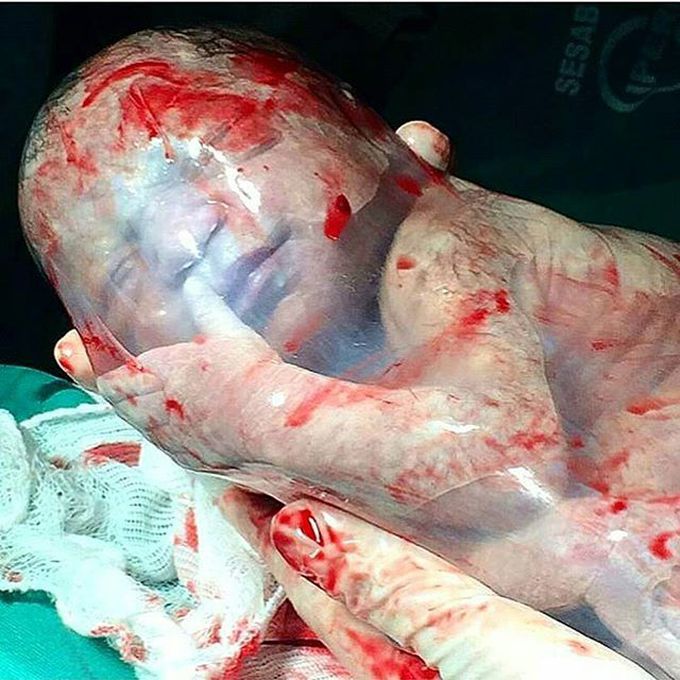 Baby born while still in a fully intact amniotic sac. 