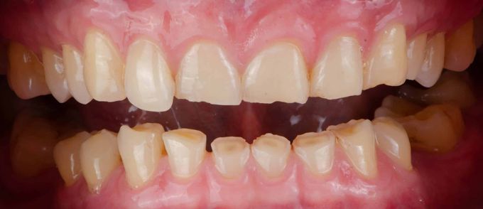 Bruxism (Teeth Grinding)