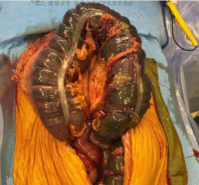 Dead colon as a result of sepsis