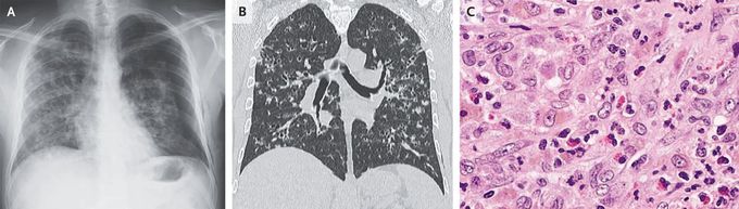 Pulmonary Langerhans-Cell Histiocytosis