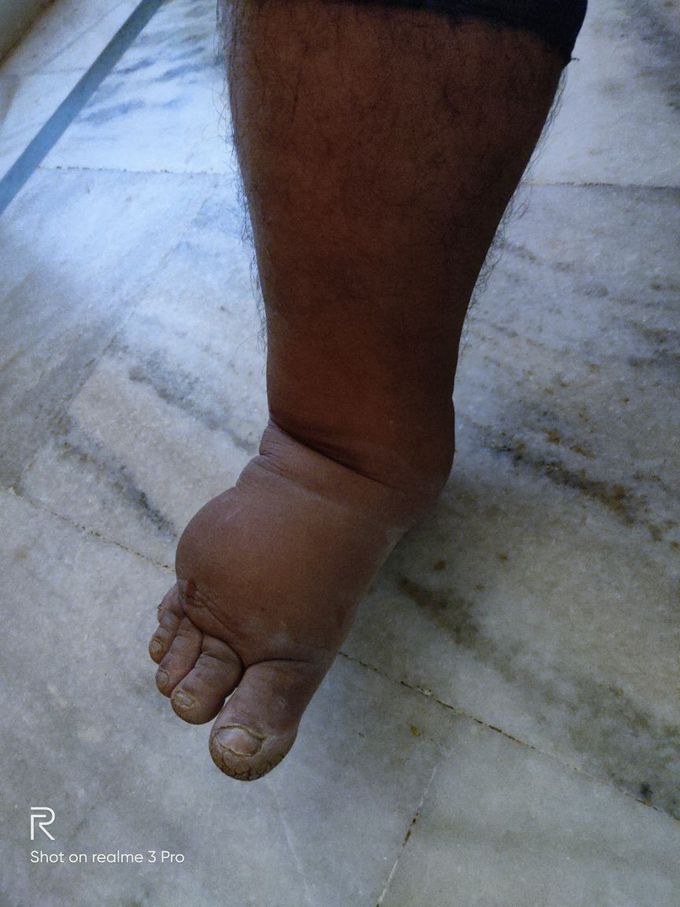Cellulitis