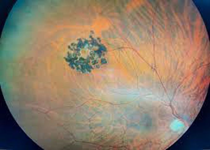 Symptoms and signs of retinal hole