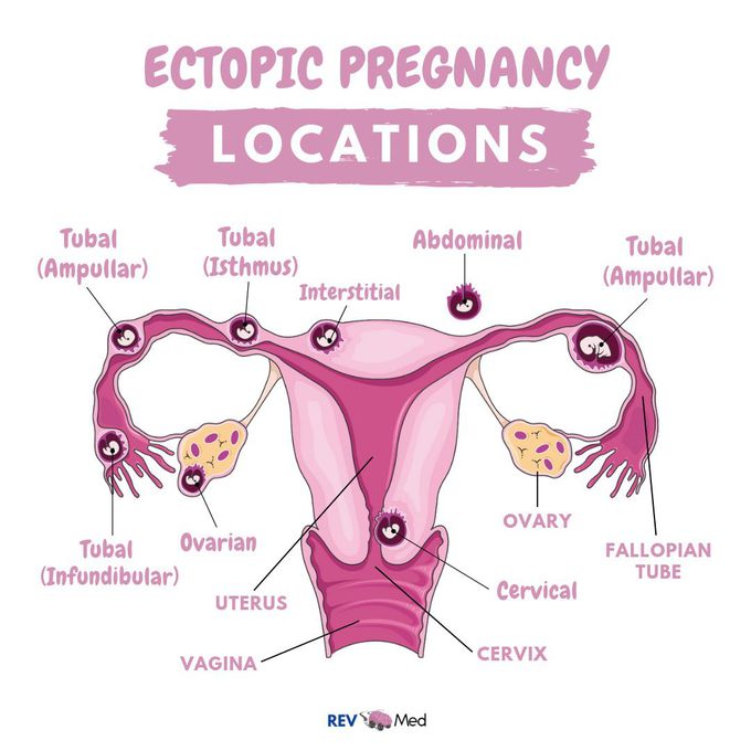 Ectopic Pregnancy & it’s locations! REV Med