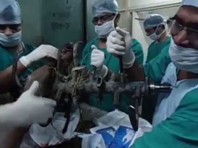 A rare foreign body in leg removed