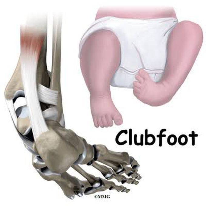 Talipes Equinovarus- Club Foot