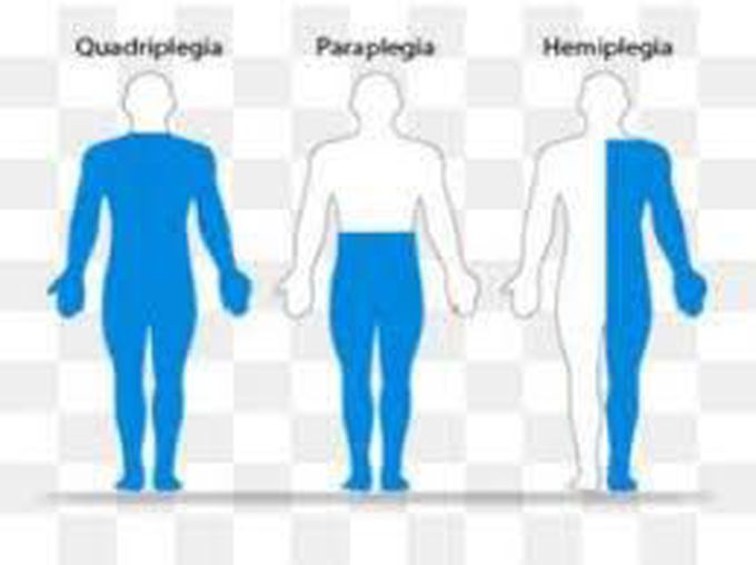 Quadriplegia Paraplegia and Hemiplegia