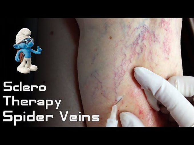 Sclerotherapy Procedure