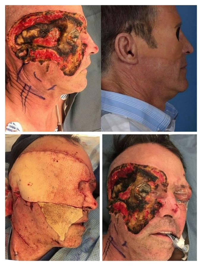 FACIAL TRAUMA RECONSTRUCTION!