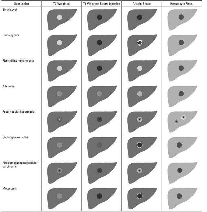 Typical Imaging Appearance of Focal Liver Lesions Before and After Injection of Gadoxetate Disodium (Primovist/Eovist) (Ringe et al., 2010)